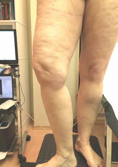 VariceDopoIlTrattamento