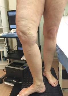 VaricePrimaDellaScleroterapia