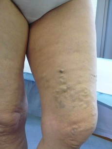 Il trattamento con scleroterapia laser-assistita (LAFOS)