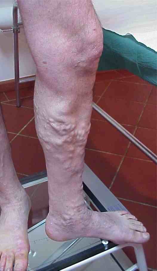 salvare la safena salvarelasafena